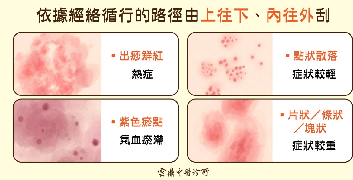 刮痧頻率