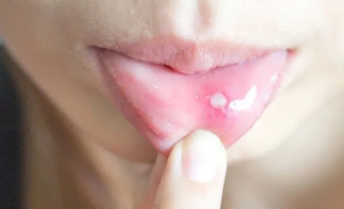 嘴巴破洞治療